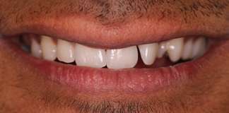 Affordable and Best Bone Grafting Procedure by Dr. Aastha Chandra at Opal Dental Care Studio in Mumbai
