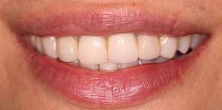 Before and After Extractions by Dr. Aastha Chandra in Juhu, Mumbai - Opal Dental Care Studio