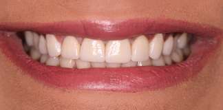 Smile Makeover Using Porcelain Veneers By Dr. Aastha Chandra At Opal Dental Care Studio