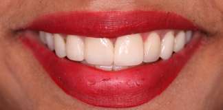 Closing Gaps Between Teeth With Smile Designing And Veneers By Dr. Aastha Chandra At Opal Dental Care Studio