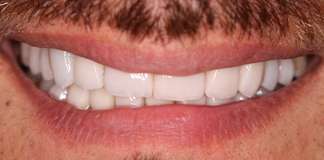 Replacing Old Veneers With New Ones Smile Designing By Dr. Aastha Chandra At Opal Dental Care Studio.