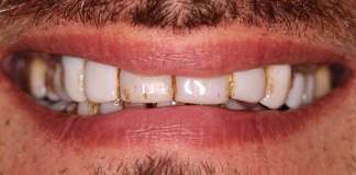Replacing Old Veneers With New Ones Smile Designing By Dr. Aastha Chandra At Opal Dental Care Studio.