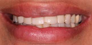 Replacing Old Chipped Composite Veneers With New Porcelain Veneers By Dr. Aastha Chandra At Opal Dental Care Studio, Mumbai, India