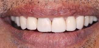 Full Mouth Rehabilitation Using Dental Implants And Crowns By Dr. Aastha Chandra At Opal Dental Care Studio.