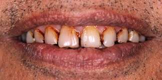 Full Mouth Rehabilitation Using Dental Implants And Crowns By Dr. Aastha Chandra At Opal Dental Care Studio.