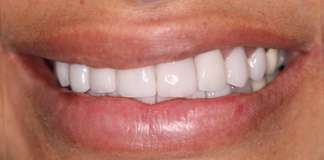 Replacing Old Chipped Composite Veneers With New Porcelain Veneers By Dr. Aastha Chandra At Opal Dental Care Studio, Mumbai, India
