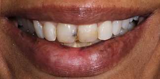 Front Two Teeth Porcelain Veneers Smile Designing By Dr. Aastha Chandra At Opal Dental Care Studio, Mumbai, India.