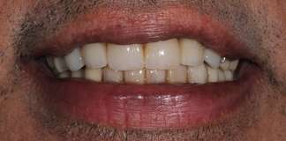 Replace Worn Out, Decayed And Missing Teeth With Dental Implants And Crowns By Dr. Aastha Chandra At Opal Dental Care Studio, Mumbai, India.