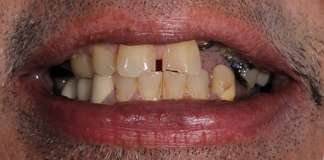 Replace Worn Out, Decayed And Missing Teeth With Dental Implants And Crowns By Dr. Aastha Chandra At Opal Dental Care Studio, Mumbai, India.