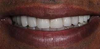 Dr. Aastha Chandra At Opal Dental Care Studio Transforming Smiles Using Dental Implants And Zirconia Crowns