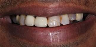 Dr. Aastha Chandra At Opal Dental Care Studio Transforming Smiles Using Dental Implants And Zirconia Crowns