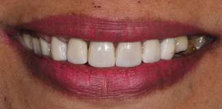 Full Mouth Reconstruction Using Dental Implants And Zirconia Crowns By Dr. Aastha Chandra At Opal Dental Care Studio, Mumbai, India.