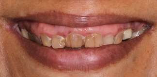 Full Mouth Reconstruction Using Dental Implants And Zirconia Crowns By Dr. Aastha Chandra At Opal Dental Care Studio, Mumbai, India.