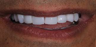 Before And After Image Of A Full Mouth Rehabilitation Using Dental Implants And Crowns By Dr. Aastha Chandra At Opal Dental Care Studio, Mumbai, India.