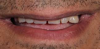 Before And After Image Of A Full Mouth Rehabilitation Using Dental Implants And Crowns By Dr. Aastha Chandra At Opal Dental Care Studio, Mumbai, India.