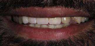 Replacement Of Missing And Decayed Teeth Using Zirconia Crowns By Dr. Aastha Chandra At Opal Dental Care Studio, Mumbai, India.
