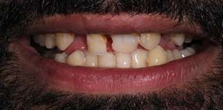 Replacement Of Missing And Decayed Teeth Using Zirconia Crowns By Dr. Aastha Chandra At Opal Dental Care Studio, Mumbai, India.