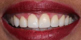Gum Contouring And Porcelain Veneers Used To Transform Smiles By Dr. Aastha Chandra At Opal Dental Care Studio, Mumbai, India.
