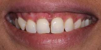 Gum Contouring And Porcelain Veneers Used To Transform Smiles By Dr. Aastha Chandra At Opal Dental Care Studio, Mumbai, India.