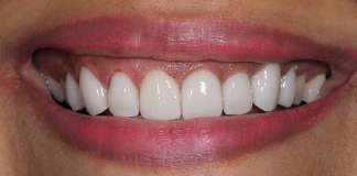 Before And After Image Of A Smile Transformation By Dr. Aastha Chandra At Opal Dental Care Studio, Mumbai, India.