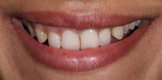 Before And After Image Of A Smile Transformation By Dr. Aastha Chandra At Opal Dental Care Studio, Mumbai, India.