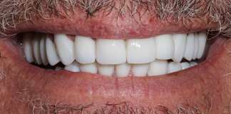 Full Mouth Rehabilitation Using Zirconia Crowns And Implants By Dr. Aastha Chandra At Opal Dental Care Studio, Mumbai, India