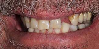 Full Mouth Rehabilitation Using Zirconia Crowns And Implants By Dr. Aastha Chandra At Opal Dental Care Studio, Mumbai, India