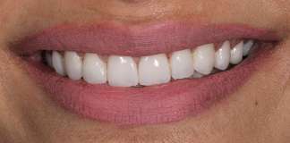 Smile Designing Using Porcelain Veneers By Dr. Aastha Chandra At Opal Dental Care Studio, Mumbai, India.