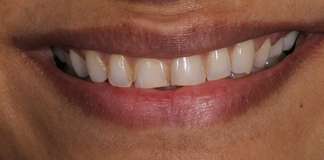 Smile Designing Using Porcelain Veneers By Dr. Aastha Chandra At Opal Dental Care Studio, Mumbai, India.