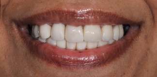 Beautiful & Natural Looking Smile Restoration By Dr. Aastha Chandra At Opal Dental Care Studio.