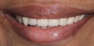 Before And After Image Of A Smile Transformation Using Dental Implants And Crowns By Dr. Aastha Chandra At Opal Dental Care Studio, Mumbai, India