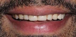 Painless & Quick Smile Transformation By Dr. Aastha Chandra At Opal Dental Care Studio.