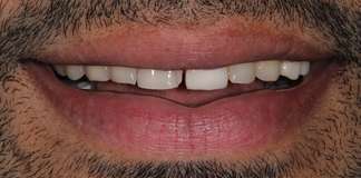 Painless & Quick Smile Transformation By Dr. Aastha Chandra At Opal Dental Care Studio.
