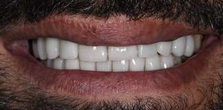 Smile Transformation Using Gum Procdeures And Porcelain Veneers By Dr. Aastha Chandra At Opal Dental Care Studio, Mumbai, India