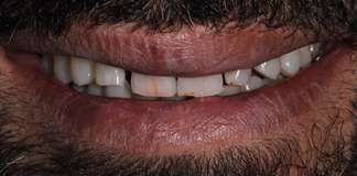 Smile Transformation Using Gum Procdeures And Porcelain Veneers By Dr. Aastha Chandra At Opal Dental Care Studio, Mumbai, India