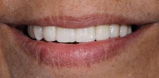 Complete Smile Transformation Using Dental Implants And Crowns By Replacing All Missing Teeth By Dr. Aastha Chandra At Opal Dental Care Studio, Mumbai, India.