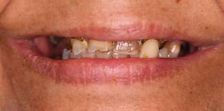 Complete Smile Transformation Using Dental Implants And Crowns By Replacing All Missing Teeth By Dr. Aastha Chandra At Opal Dental Care Studio, Mumbai, India.