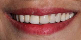 Full Mouth Rehabilitation Using Zirconia Crowns And Implants By Dr. Aastha Chandra At Opal Dental Care Studio, Mumbai, India