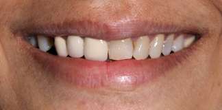 Full Mouth Rehabilitation Using Zirconia Crowns And Implants By Dr. Aastha Chandra At Opal Dental Care Studio, Mumbai, India