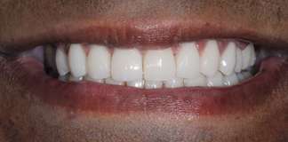 Smile Designing Using Porcelain Veneers By Dr. Aastha Chandra At Opal Dental Care Studio, Mumbai, India.