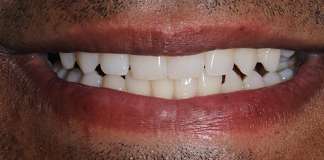 Smile Designing Using Porcelain Veneers By Dr. Aastha Chandra At Opal Dental Care Studio, Mumbai, India.