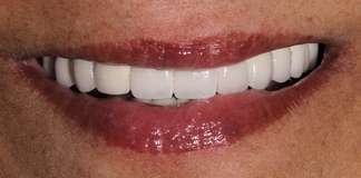 Full Mouth Restoration For An International Patient At Opal Dental Care Studio.
