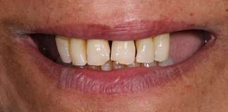 Full Mouth Restoration For An International Patient At Opal Dental Care Studio.