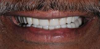 Before And After Image Of A Smile Transformation Using Dental Implants And Crowns By Dr. Aastha Chandra At Opal Dental Care Studio, Mumbai, India