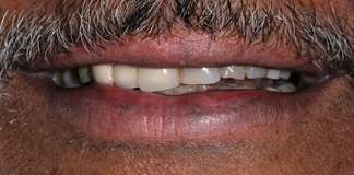 Before And After Image Of A Smile Transformation Using Dental Implants And Crowns By Dr. Aastha Chandra At Opal Dental Care Studio, Mumbai, India