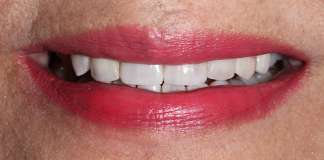 Before And After Image Of A Smile Transformation Using Dental Implants And Crowns By Dr. Aastha Chandra At Opal Dental Care Studio, Mumbai, India