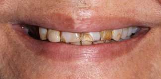 Before And After Image Of A Smile Transformation Using Dental Implants And Crowns By Dr. Aastha Chandra At Opal Dental Care Studio, Mumbai, India