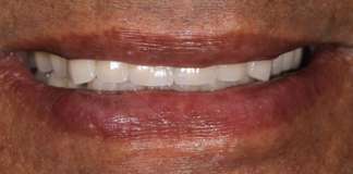 Full Mouth Rehabilitation Using Zirconia Crowns And Implants By Dr. Aastha Chandra At Opal Dental Care Studio, Mumbai, India