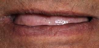 Full Mouth Rehabilitation Using Zirconia Crowns And Implants By Dr. Aastha Chandra At Opal Dental Care Studio, Mumbai, India