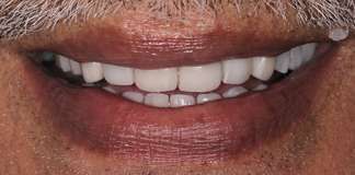 Smile Designing Using Porcelain Veneers By Dr. Aastha Chandra At Opal Dental Care Studio, Mumbai, India.